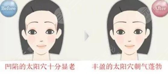 玻尿酸丰太阳穴能保持多久？术后的注意事项有哪些？