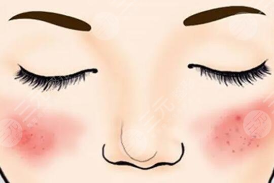 彩光祛红血丝的危害有哪些？它的原理是什么？注意事项有哪些？