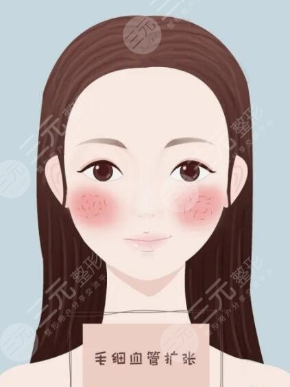 彩光祛红血丝注意事项