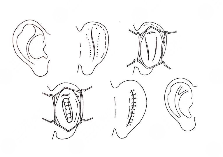 全耳再造手术费用多少钱？