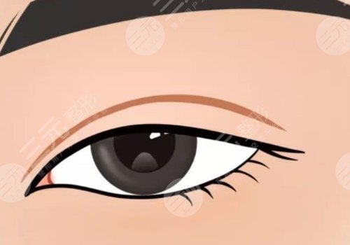 双眼皮修复大概多少钱呢？