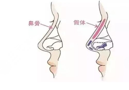 硅胶隆鼻假体可以维持一辈子吗？