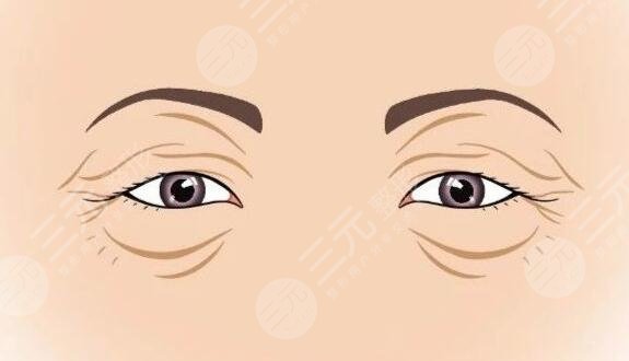 　　眼睑皮肤松弛矫正术适合哪些人群?在开展缓解之前，越来越多的人都咨询过这个问题，因为通过做该缓解，能够让眼部周围的肌肤更加的紧致和光滑，不会出现松弛的感觉，而且也能够让整个人的皮肤状态看上去更加的美观和协调。但是做完缓解之后也有可能会出现一些后遗症，所以适用的人群是不同。那么，眼睑皮肤松弛矫正术适合哪些人群?一起来看!  　　一、眼睑皮肤松弛是什么?  　　上眼睑松弛多由于上眼皮脂肪过多所致，整个人眼部周围的肌肤看上去是比较松弛的，没有美观的感觉。如果不进行及时的缓解和改良的话，那么整个人的皮肤会变薄然后变松，整个人的肌肤弹性会越来越小，松弛的程度也会更加的严重，整个人体的皮肤也会产生一定的萎缩。  　　二、眼睑皮肤松弛矫正术适合哪些人群?  　　矫正手术适合人群，其实是比较多元化的，而且并非单纯从年龄角度考虑，主要是看人体的眼角以及眉毛的松弛程度，也要看外眦皮肤松弛情况、上睑重睑松弛情况，然后根据实际状态制定针对性的手术方案，然后再判断是否可以进行矫正手术。  　　通过上睑松弛矫正术，同时也可以通过眉上切口或眉下切口，能够让整个人的眼部协调感更好，同时能够达到面部年轻化的效果，而且还能够让眼部周围的肌肤更加的紧致。随着求美人士对面部美容的关注，这种缓解方式能够让受术者得到更好的调节，并且皮肤状态也会更加的美观。  　　1、上眼睑松弛多见于中、老年人，所以说这类人群一般是比较适合的。随着年龄的增长，皮肤在慢慢的变薄，然后变得更加的松弛，所以说肌肤也缺乏弹性，这类人群的眼轮匝肌变性松弛、眼眶隔膜松弛萎缩，所以可以通过做该手术进行一定的改良和调。  　　2、眼睑松弛尤其是上眼睑松弛这类人群，也可以通过做这类缓解，进行一定的调节。严重的引起睑裂变小，从而导致遮盖瞳孔而影响视力影响视野，因此进行一定的改良，能够让肌肤更加的紧致，而且也能够让生活更加的方便。有的可见倒睫毛刺激眼球引起不适，通过做该手术可以更好的改良。眼睑松弛影响美观，也影响视野，所以做了这类缓解之后，皮肤也会更加的紧致，皱纹也会越来越少。  　　三、眼睑皮肤松弛矫正术注意事项  　　上眼睑松弛影响美观影响视野，可以在专业医生的指导下做手术进行一定的调节，但是一定要进行术前的检查然后根据自己的实际状态进行操作。手术后遵从医嘱，及时使用抗炎药物，不能够吃太多辛辣刺激性以及油腻的食物，避免感染发生，定期眼科检查，如果出现了问题也要进行及时的缓解，而且伤口不能够沾水，否则可能也会出现感染的。  　　做完缓解之后不能够用力按压自己肌肤，否则有可能会出现剧烈的疼痛感，还有可能会出现炎症的现象，因此一定要进行针对性的护理，才能够让整个人的眼部周围的肌肤更加的紧致，一旦出现了松弛，就要进行及时的干预和改良。日常生活中也要早一点休息，尽量减少熬夜，才能够让整个人的皮肤更加的健康。在熬夜的过程中，可能会出现内分泌系统失调，周围的肌肤状态也会更加的衰老，还有可能会出现皱纹加重的现象，因此一定要早睡早起，调节好生活作息时间。