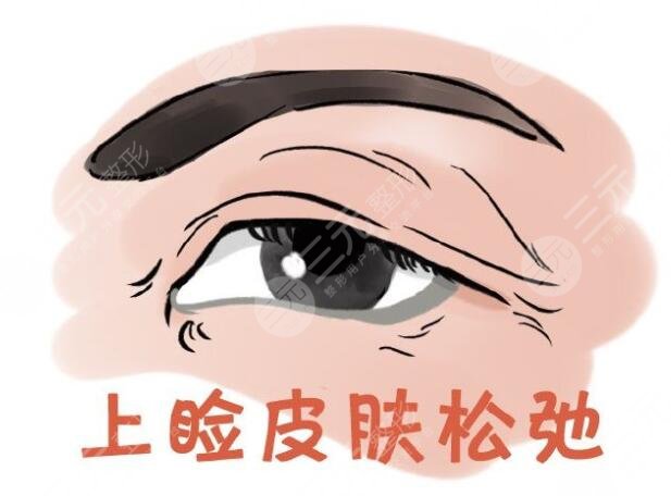 眼睑皮肤松弛是什么?