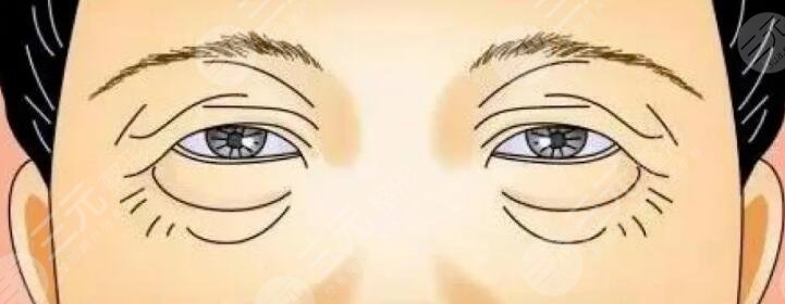 眼睑皮肤松弛矫正术注意事项