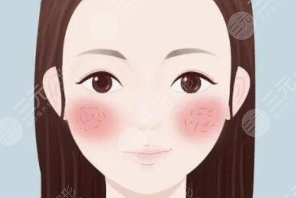 脸上红血丝泛红怎么办?