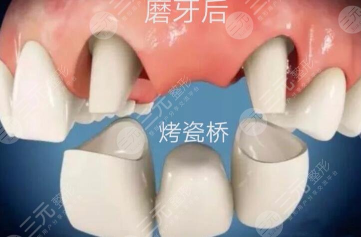 全瓷牙价格影响的因素