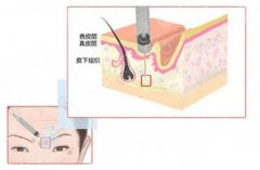 骨相抗衰注射什么好?医美小课堂介绍,带你一起体验紧致美肌! 骨相抗衰注射什么好?医美小课堂介绍,带你一起体验紧致美肌!