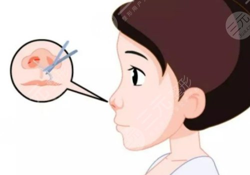 鼻头缩小手术的费用大概是多少啊