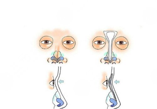 鼻头缩小手术的费用大概是多少啊