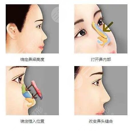 隆鼻手术是什么原理?