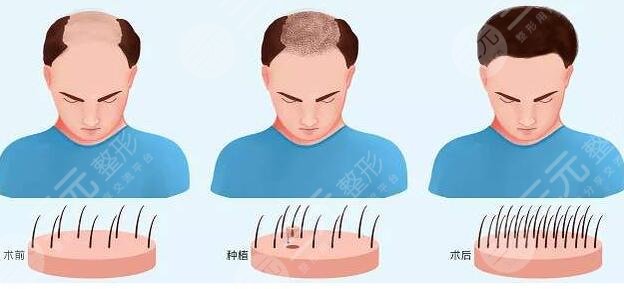 植发过程介绍