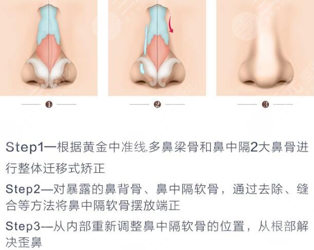 鼻子歪斜是什么原因造成的