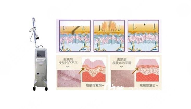 有伤疤怎么去掉？