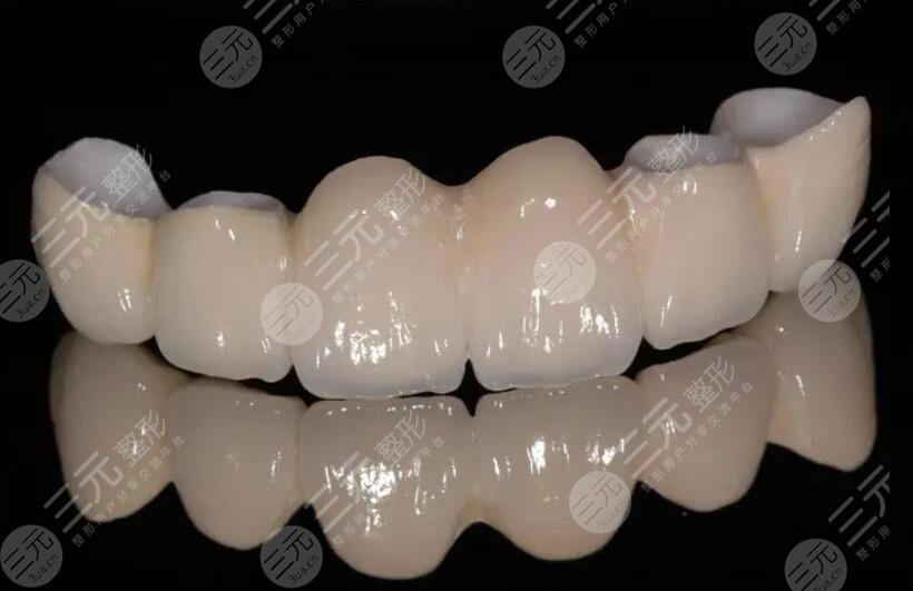 影响烤瓷牙价格的因素有哪些?