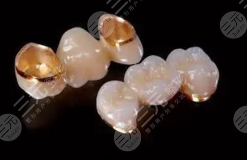 烤瓷牙的分类都有哪些?