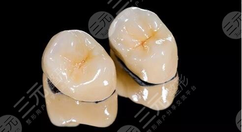 做烤瓷牙价格多少钱一颗？影响价格高低因素/烤瓷牙的分类有哪些？