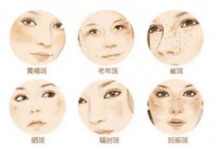 如何祛除脸上黄褐斑？5种不同方案分享，淡斑美肌必修课！