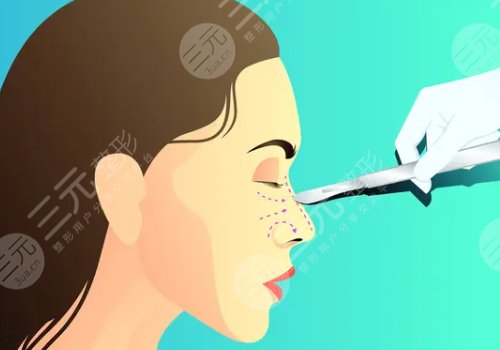 贵阳美贝尔徐威做鼻子多少钱?