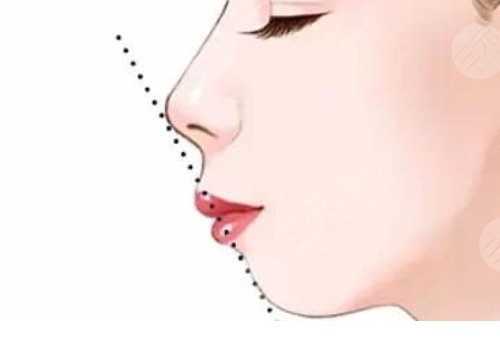 嘴凸是怎么造成的?