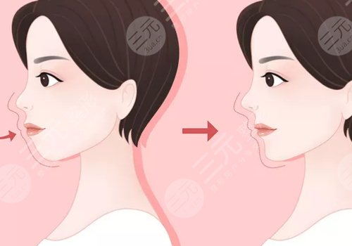 嘴凸是怎么造成的?