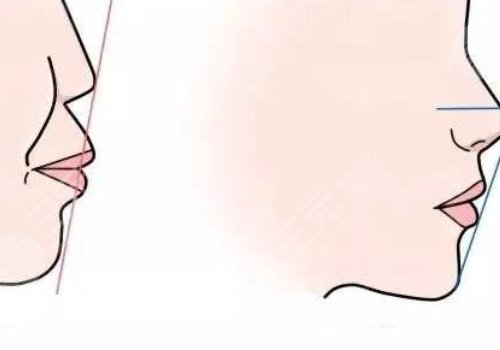 嘴凸是怎么造成的?