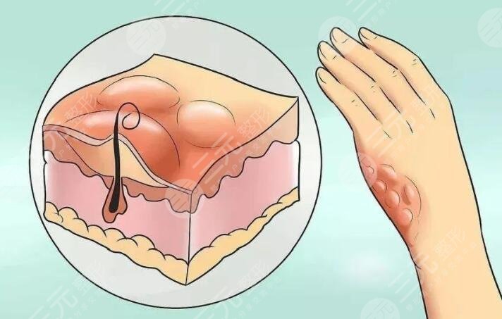 像素激光去疤痕要做多少次才会好？项目定价、注意事项有哪些？