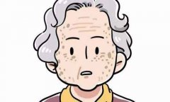 老人斑怎么除掉？4种方案介绍，有用性对比！