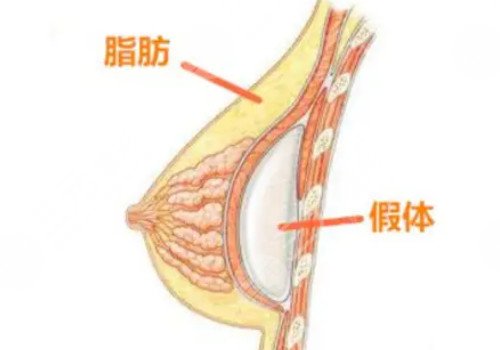 曼托假体丰胸4个月还摸的到假体正常吗