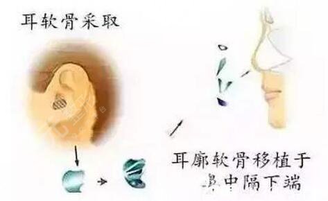 自体软骨隆鼻有缺点吗?