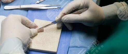 自体软骨隆鼻有缺点吗?