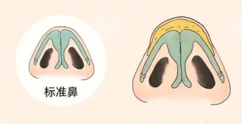 宽鼻矫正