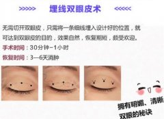 埋线双眼皮注意事项有哪些？美眼必修课超全讲解！