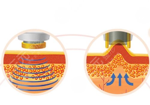 像素射频仪器祛疤有用吗？