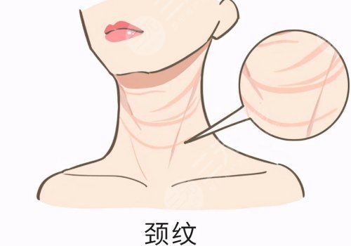 颈纹特别深怎么去除？