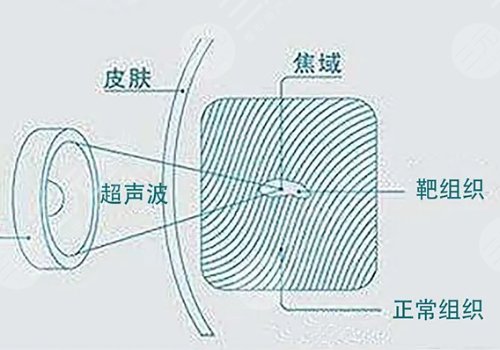 超声炮和热玛吉哪个抗衰老效果好?