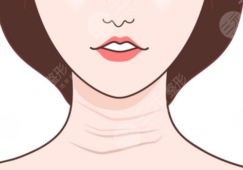 颈纹是什么原因造成的？