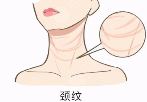 颈纹是什么原因造成的?