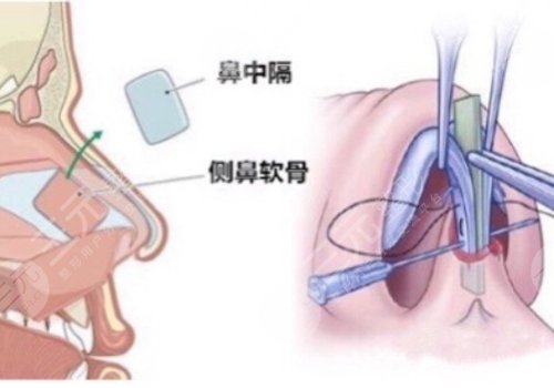 软骨隆鼻有什么后遗症?