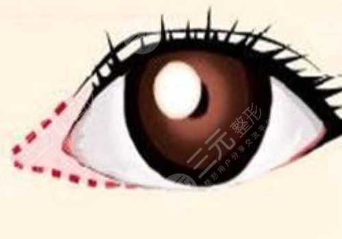 开眼角后留下的疤痕到底能不能修复？