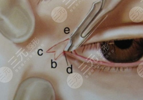 开眼角后留下的疤痕到底能不能修复？