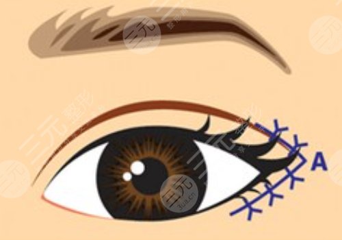 开眼角后留下的疤痕到底能不能修复？