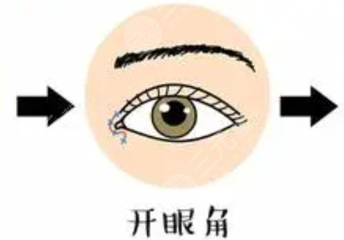 开眼角后留下的疤痕到底能不能修复？