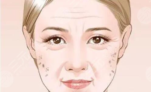 如何消除老年斑有效的方法：食疗_医美_日常护理多方面入手！