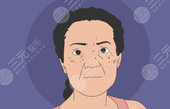 为什么会长有老年斑?