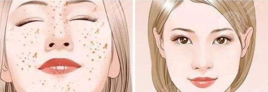 激光祛斑会不会反弹?