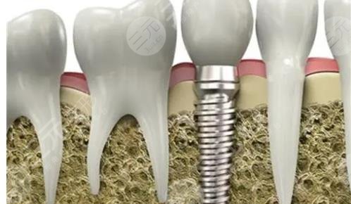 种植牙
