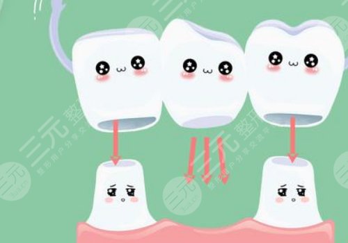 钛合金烤瓷牙多少钱一颗？