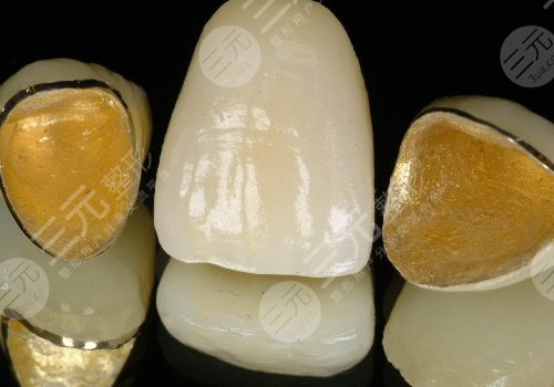 钛合金烤瓷牙多少钱一颗？