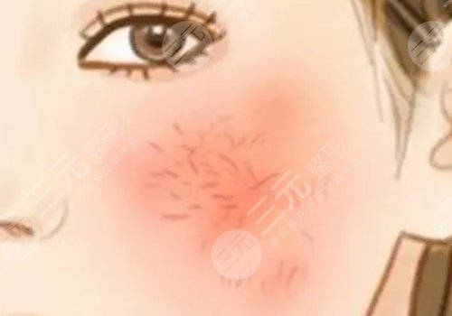 脸上长红血丝怎么去掉？